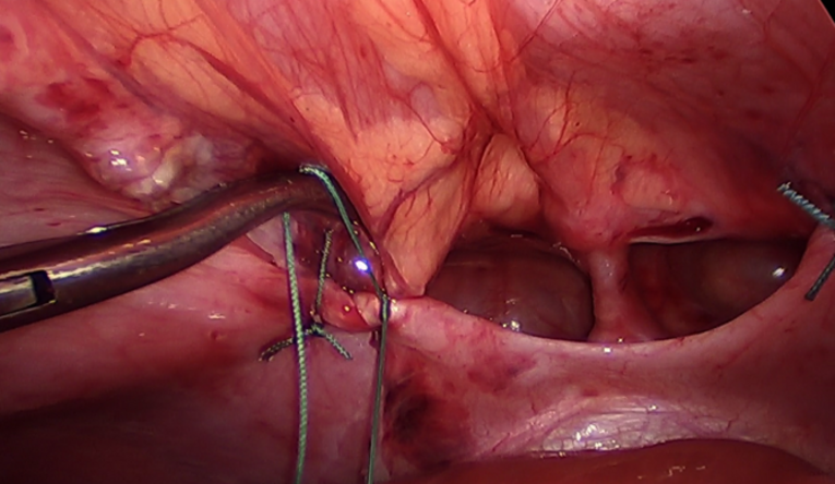 Das Bild zeigt den operativen Verschluss einer Zwerchfellhernie nach Setzen der ersten adaptierenden Naht.