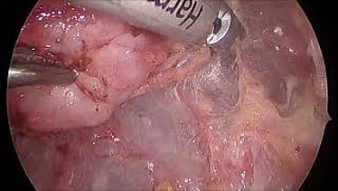 Das Bild zeigt eine intraoperative Aufnahme einer Laparoskopie, bei der ein Nebennierentumor entfernt wird.