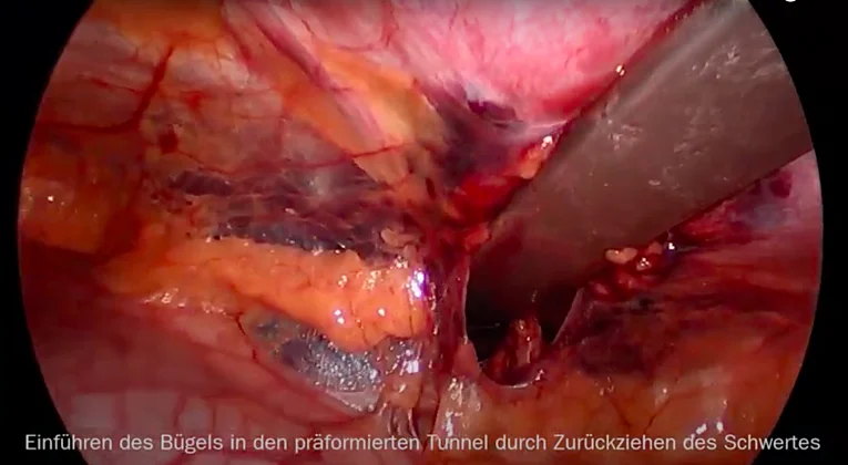 Minimal-invasive Trichterbrustkorrektur in modifizierter Nuss-Technik Das Bild zeigt den intraoperativen Befund des eingeführten Nuss-Bügels retrosternal zur Anhebung der Trichterbrust.